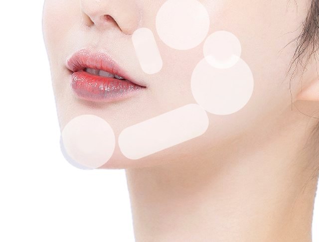 رسم خريطة لمحيط الوجه يوضح مواضع الإجراء في الذقن المتراجع وخط الفك