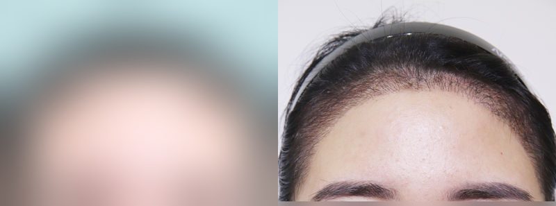 Other before-and-after comparison photo — before surgery on the left, after surgery on the right. Hairline hair transplant, 2,500 hairs
