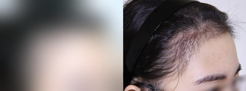 Other before-and-after comparison photo — before surgery on the left, after surgery on the right. Hairline hair transplant, 2,500 hairs