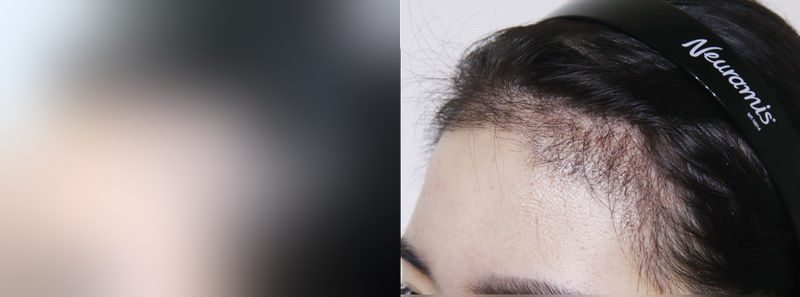 Other before-and-after comparison photo — before surgery on the left, after surgery on the right. Hairline hair transplant, 2,500 hairs