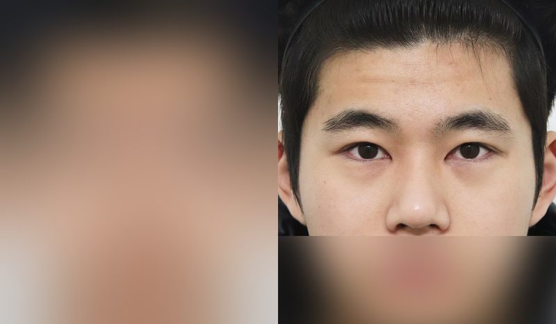 Eye surgery before-and-after comparison photo — before surgery on the left, after surgery on the right. Incisional double eyelid surgery + eye shape correction + epicanthoplasty + dorsal hump removal + tip correction (septal cartilage)