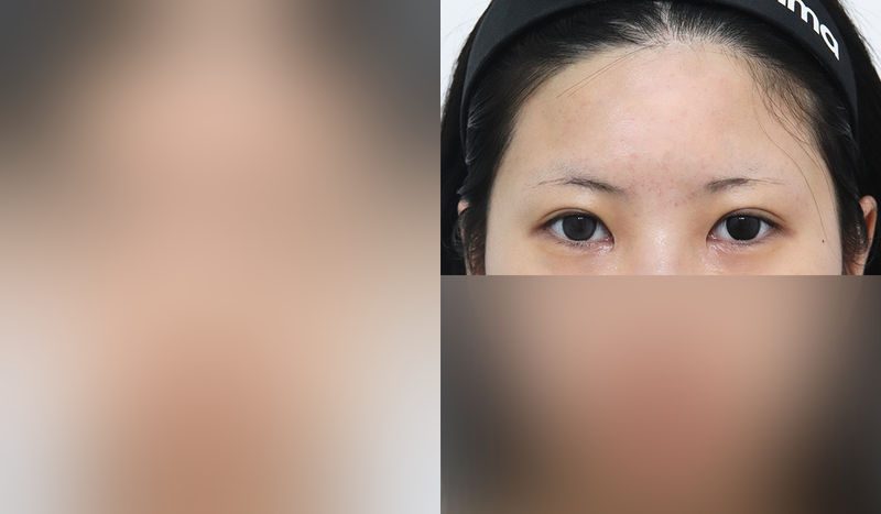 Eye surgery before-and-after comparison — left is before surgery, right is after. Incisional + Eye Shape Correction + Medial Canthoplasty
