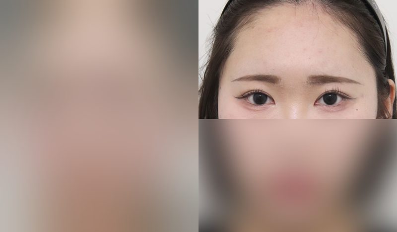 Eye surgery before-and-after comparison photo — before surgery on the left, after surgery on the right. [Revision eye surgery] Incisional double eyelid surgery + eye shape correction + lower eyelid fat repositioning
