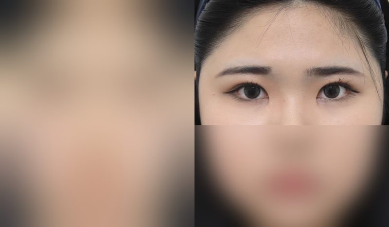 Eye surgery before-and-after comparison — left is before surgery, right is after. Incisional + Eye Shape Correction + Medial Canthoplasty