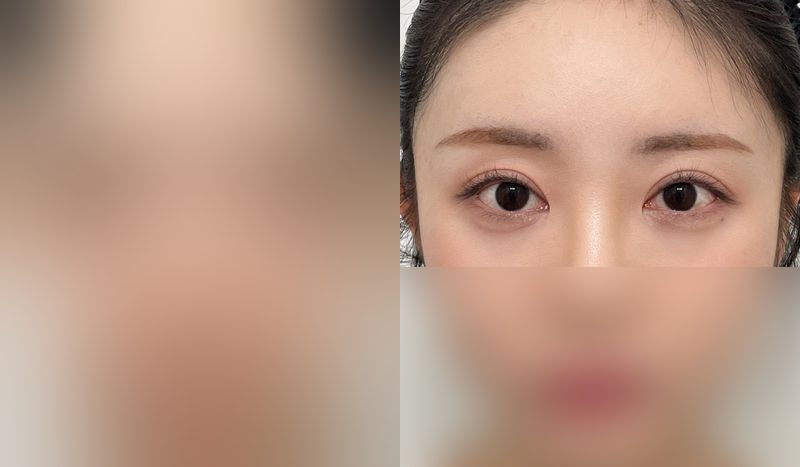 Eye surgery before-and-after comparison — left is before surgery, right is after. [Revision Eye Surgery] Incisional + Eye Shape Correction