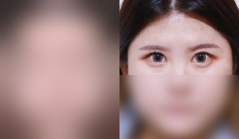 Eye surgery before-and-after comparison photo — before surgery on the left, after surgery on the right. Incisional double eyelid surgery + eye shape correction + fat repositioning (revision)