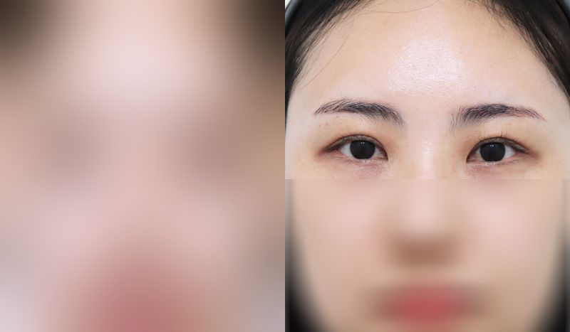 Eye surgery before-and-after comparison photo — before surgery on the left, after surgery on the right. Upper blepharoplasty + eye shape correction (revision)