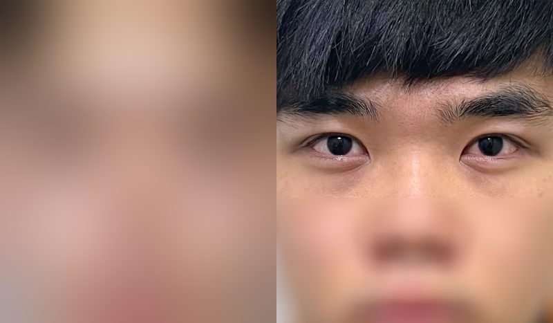 Eye surgery before-and-after comparison — left is before surgery, right is after. Incisional + Eye Shape Correction