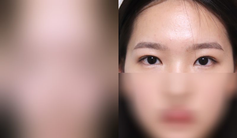Eye surgery before-and-after comparison photo — before surgery on the left, after surgery on the right. Incisional double eyelid surgery + eye shape correction + epicanthoplasty