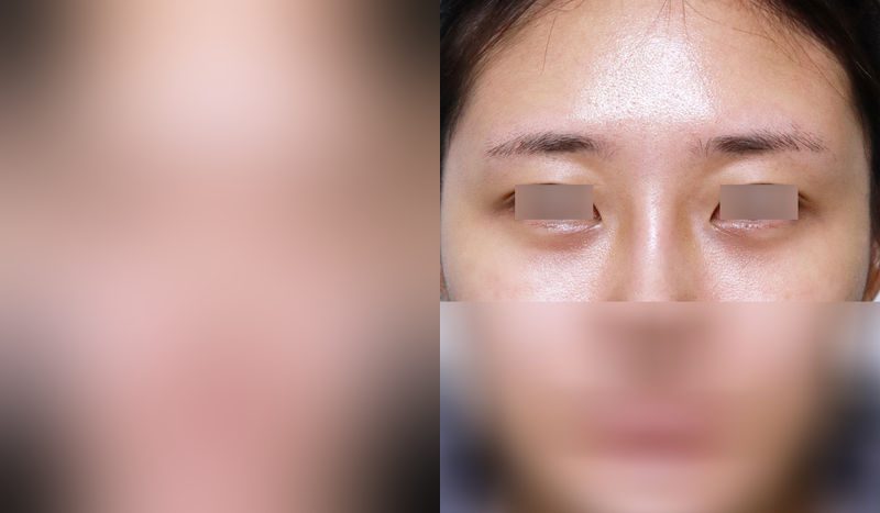 Eye surgery before-and-after comparison photo — before surgery on the left, after surgery on the right. Lower eyelid fat repositioning + fat grafting (tear trough + anterior cheek)
