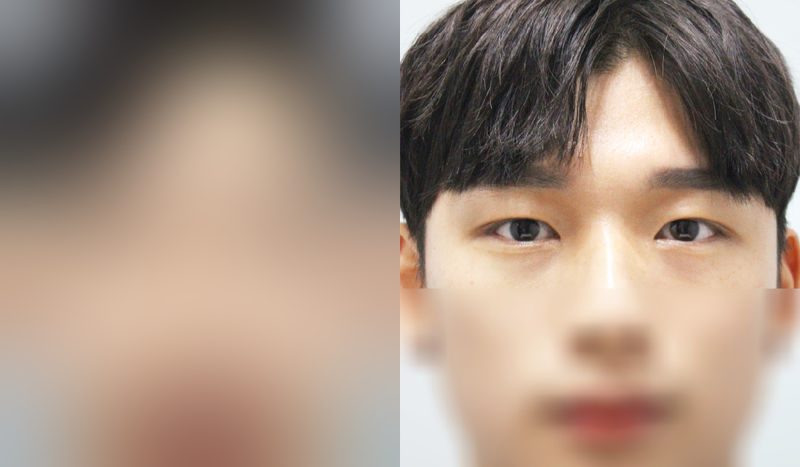Eye surgery before-and-after comparison photo — before surgery on the left, after surgery on the right. Incisional double eyelid surgery + eye shape correction + epicanthoplasty