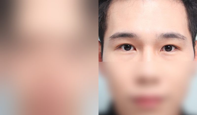 Eye surgery before-and-after comparison — left is before surgery, right is after. Incisional + Eye Shape Correction