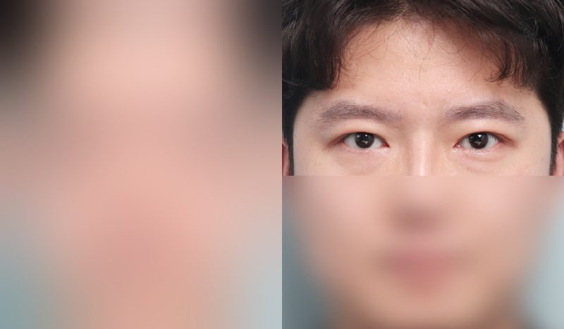 Eye surgery before-and-after comparison photo — before surgery on the left, after surgery on the right. Incisional double eyelid surgery + eye shape correction + epicanthoplasty