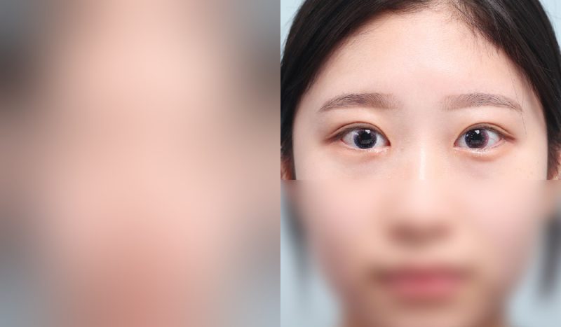Eye surgery before-and-after comparison photo — before surgery on the left, after surgery on the right. Incisional double eyelid surgery + eye shape correction + epicanthoplasty