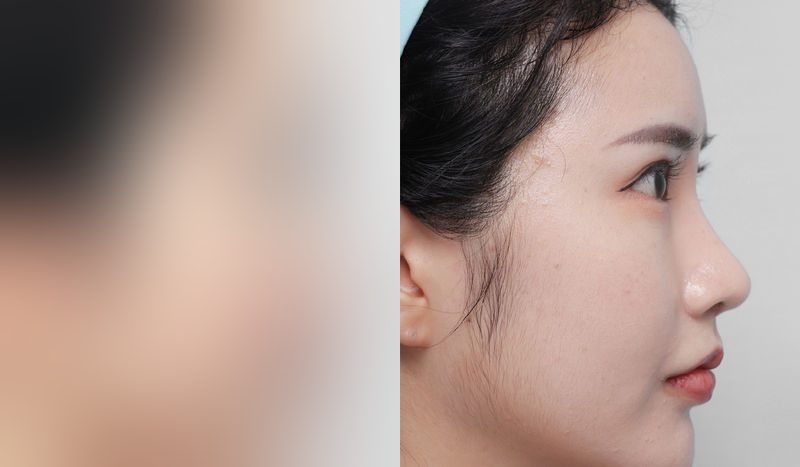 Before-and-after photos of eye surgery — before surgery on the left, after surgery on the right. Incisional double eyelid surgery (revision) + eye shape correction + combined canthoplasty + nasal bridge + nasal tip (septal) + hump nose + arrow nose correction