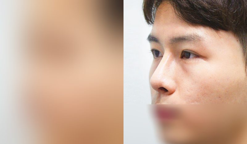 Before-and-after photos of eye surgery — before surgery on the left, after surgery on the right. Incisional double eyelid surgery (revision) + eye shape correction + epicanthoplasty + nasal bridge + nasal tip (septal) + hump nose + crooked nose correction + lateral osteotomy