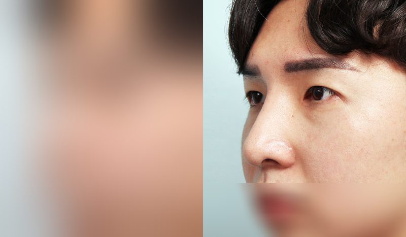 Before-and-after photos of eye surgery — before surgery on the left, after surgery on the right. Incisional double eyelid surgery + eye shape correction + epicanthoplasty + nasal bridge + nasal tip (septal) + hump nose + lateral osteotomy
