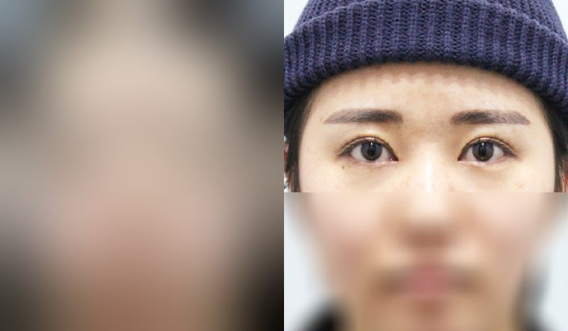 Eye surgery before-and-after comparison photo — before surgery on the left, after surgery on the right. Incisional double eyelid surgery + eye shape correction + epicanthoplasty