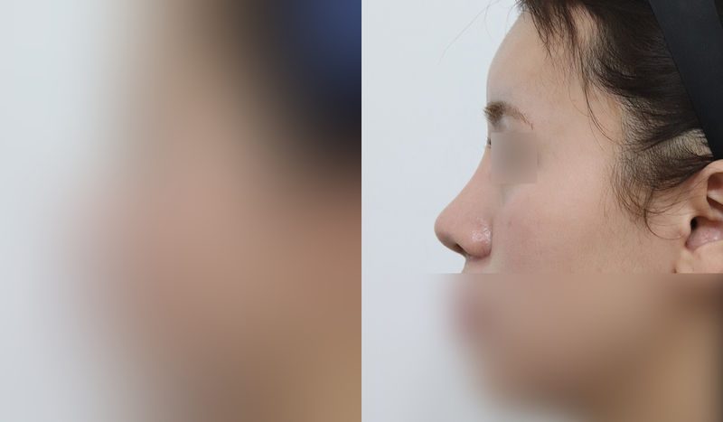 Rhinoplasty before-and-after comparison photo — before surgery on the left, after surgery on the right. Functional rhinoplasty + dorsal hump removal + tip correction (septal cartilage) + lateral and medial osteotomy + alar reduction