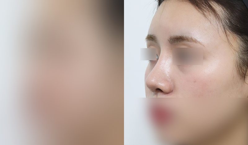Rhinoplasty before-and-after comparison photo — before surgery on the left, after surgery on the right. Functional rhinoplasty + dorsal hump removal + tip correction (septal cartilage) + lateral and medial osteotomy + alar reduction