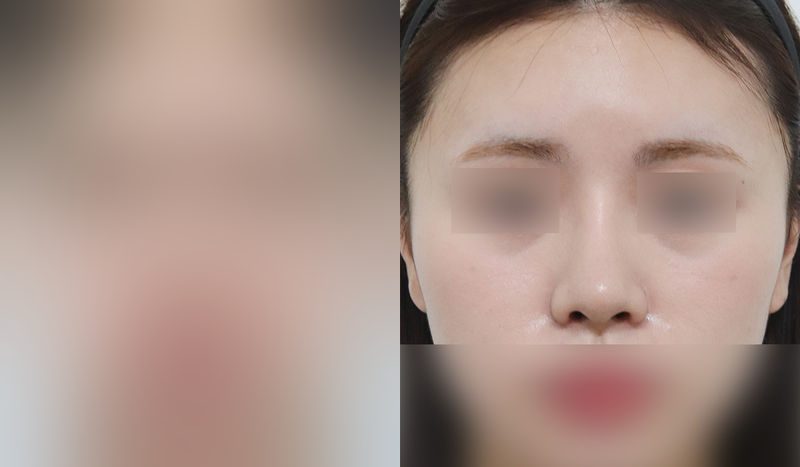 Rhinoplasty before-and-after comparison photo — before surgery on the left, after surgery on the right. Functional rhinoplasty + dorsal hump removal + tip correction (septal cartilage) + lateral and medial osteotomy + alar reduction