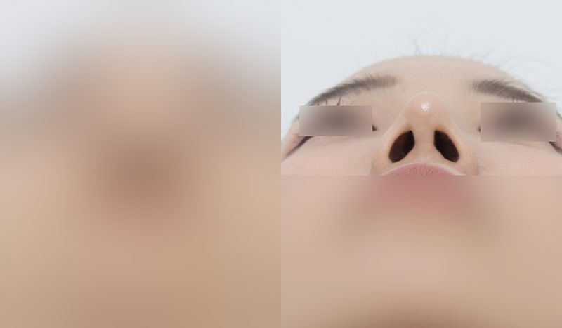 Rhinoplasty before-and-after comparison photo — before surgery on the left, after surgery on the right. Dorsal hump removal + tip correction (septal cartilage) + lateral and medial osteotomy + alar reduction