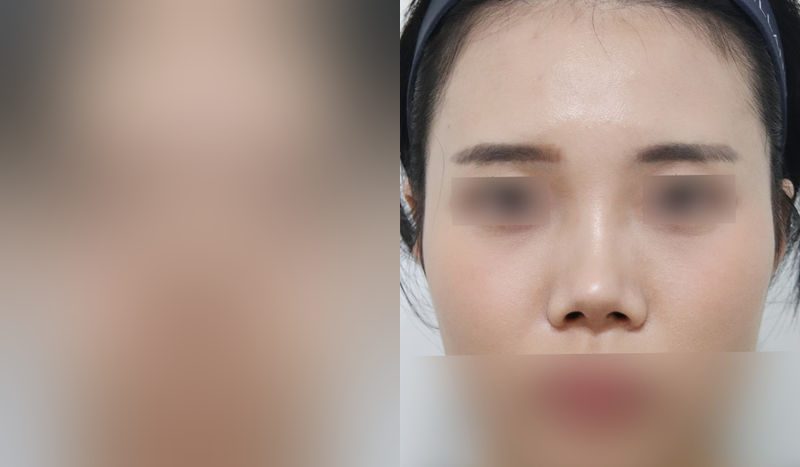 Rhinoplasty before-and-after comparison photo — before surgery on the left, after surgery on the right. Dorsal hump removal + tip correction (septal cartilage) + lateral and medial osteotomy + alar reduction
