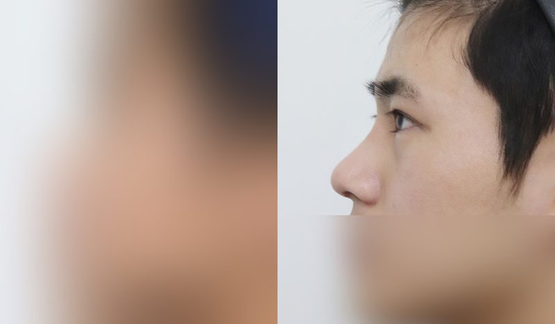 Rhinoplasty before-and-after comparison photo — before surgery on the left, after surgery on the right. Dorsal hump removal + tip correction (septal cartilage) + incisional double eyelid surgery + eye shape correction + epicanthoplasty