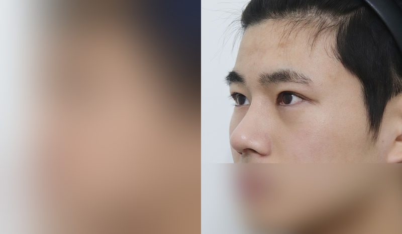 Rhinoplasty before-and-after comparison photo — before surgery on the left, after surgery on the right. Dorsal hump removal + tip correction (septal cartilage) + incisional double eyelid surgery + eye shape correction + epicanthoplasty