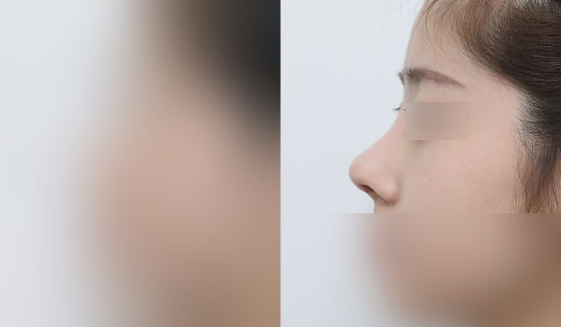 Nose surgery before-and-after comparison — left is before surgery, right is after. Revision Rhinoplasty + Dorsal Hump Removal + Tip Correction (Septal)