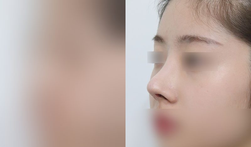 Nose surgery before-and-after comparison — left is before surgery, right is after. Revision Rhinoplasty + Dorsal Hump Removal + Tip Correction (Septal)