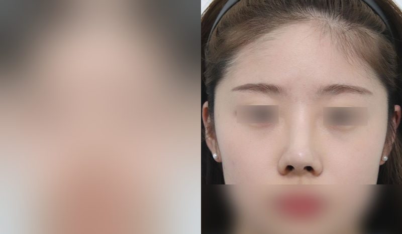 Nose surgery before-and-after comparison — left is before surgery, right is after. Revision Rhinoplasty + Dorsal Hump Removal + Tip Correction (Septal)