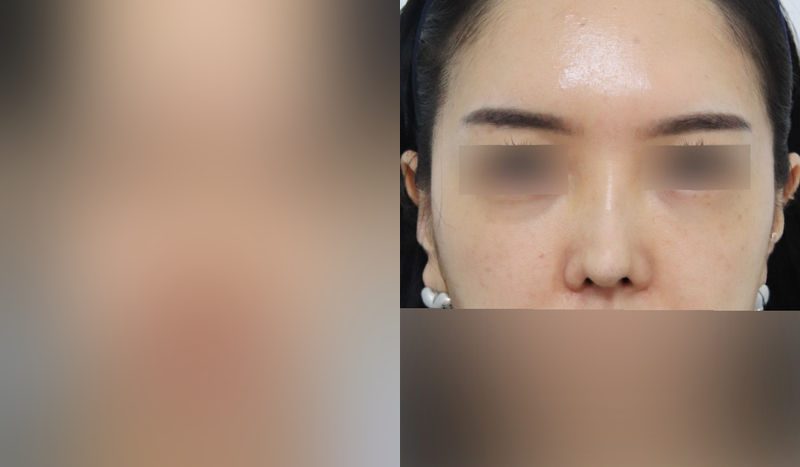 Rhinoplasty before-and-after comparison photo — before surgery on the left, after surgery on the right. Revision rhinoplasty + nasal bridge + tip correction (septal cartilage) + dorsal hump removal + alar lowering