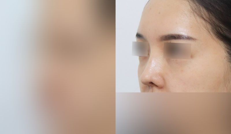 Rhinoplasty before-and-after comparison photo — before surgery on the left, after surgery on the right. Revision rhinoplasty + nasal bridge + tip correction (septal cartilage) + dorsal hump removal + alar lowering