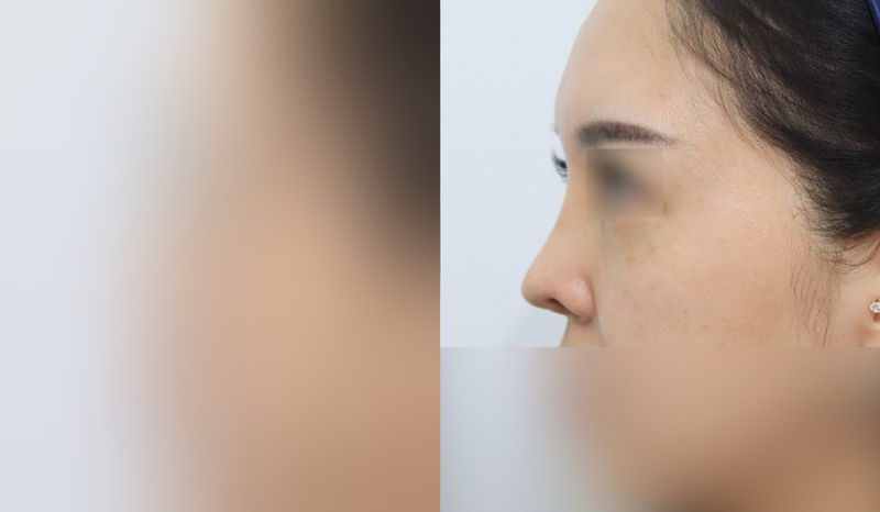 Rhinoplasty before-and-after comparison photo — before surgery on the left, after surgery on the right. Revision rhinoplasty + nasal bridge + tip correction (septal cartilage) + dorsal hump removal + alar lowering