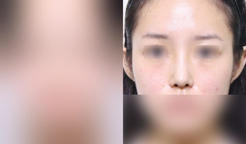 Rhinoplasty before-and-after comparison photo — before surgery on the left, after surgery on the right. Nasal bridge + tip correction (septal cartilage) + dorsal hump removal + lateral and medial osteotomy