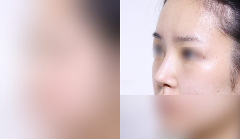 Rhinoplasty before-and-after comparison photo — before surgery on the left, after surgery on the right. Nasal bridge + tip correction (septal cartilage) + dorsal hump removal + lateral and medial osteotomy