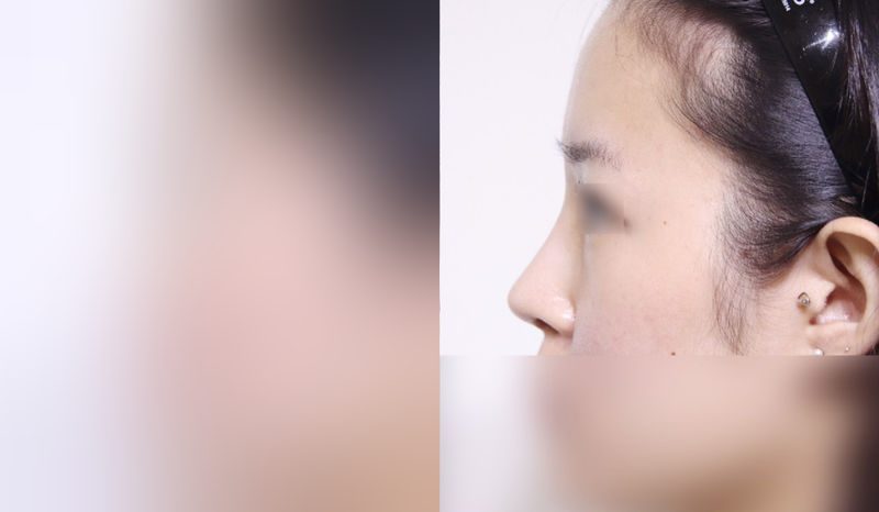 Rhinoplasty before-and-after comparison photo — before surgery on the left, after surgery on the right. Nasal bridge + tip correction (septal cartilage) + dorsal hump removal + lateral and medial osteotomy