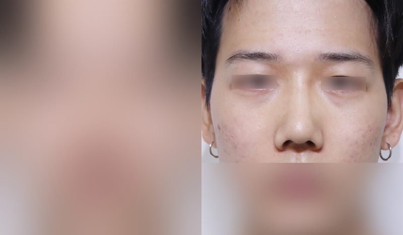 Rhinoplasty before-and-after comparison photo — before surgery on the left, after surgery on the right. Nasal bridge + tip correction (septal cartilage) + dorsal hump removal + lateral and medial osteotomy + bulbous nose