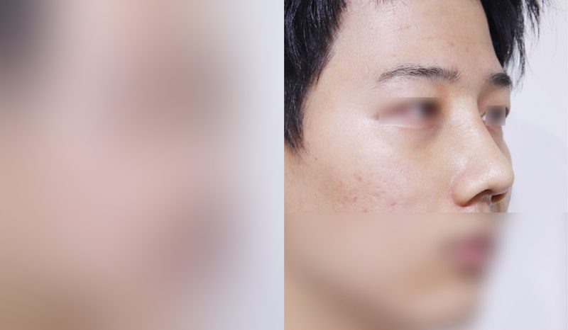 Rhinoplasty before-and-after comparison photo — before surgery on the left, after surgery on the right. Nasal bridge + tip correction (septal cartilage) + dorsal hump removal + lateral and medial osteotomy + bulbous nose