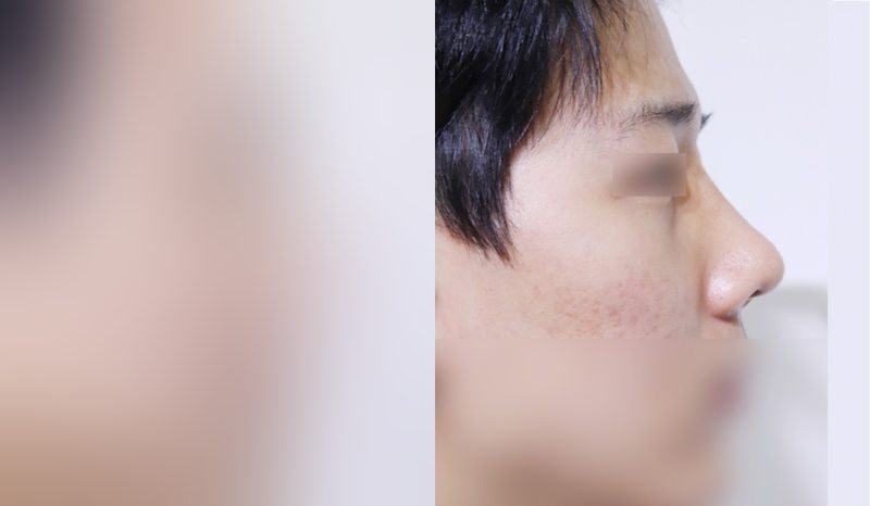 Rhinoplasty before-and-after comparison photo — before surgery on the left, after surgery on the right. Nasal bridge + tip correction (septal cartilage) + dorsal hump removal + lateral and medial osteotomy + bulbous nose