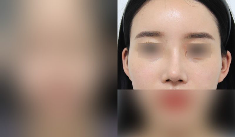Rhinoplasty before-and-after comparison photo — before surgery on the left, after surgery on the right. Nasal bridge + tip correction (septal cartilage) + dorsal hump removal + lateral and medial osteotomy + bulbous nose correction