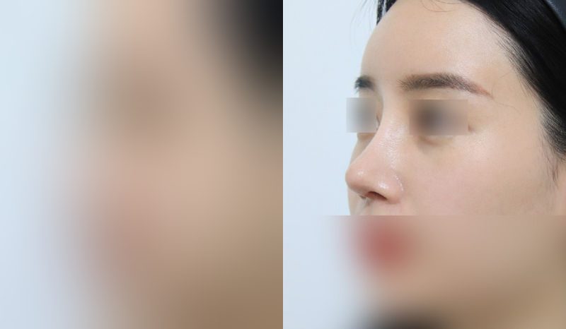 Rhinoplasty before-and-after comparison photo — before surgery on the left, after surgery on the right. Nasal bridge + tip correction (septal cartilage) + dorsal hump removal + lateral and medial osteotomy + bulbous nose correction