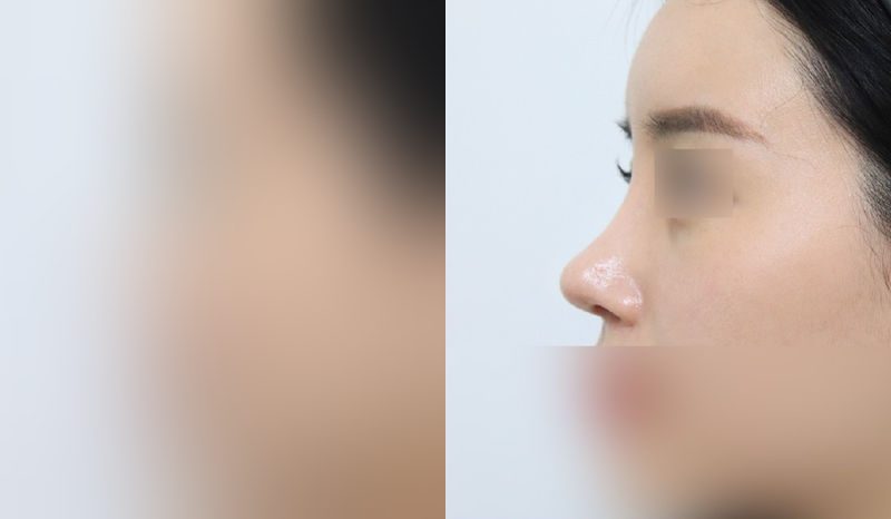 Rhinoplasty before-and-after comparison photo — before surgery on the left, after surgery on the right. Nasal bridge + tip correction (septal cartilage) + dorsal hump removal + lateral and medial osteotomy + bulbous nose correction