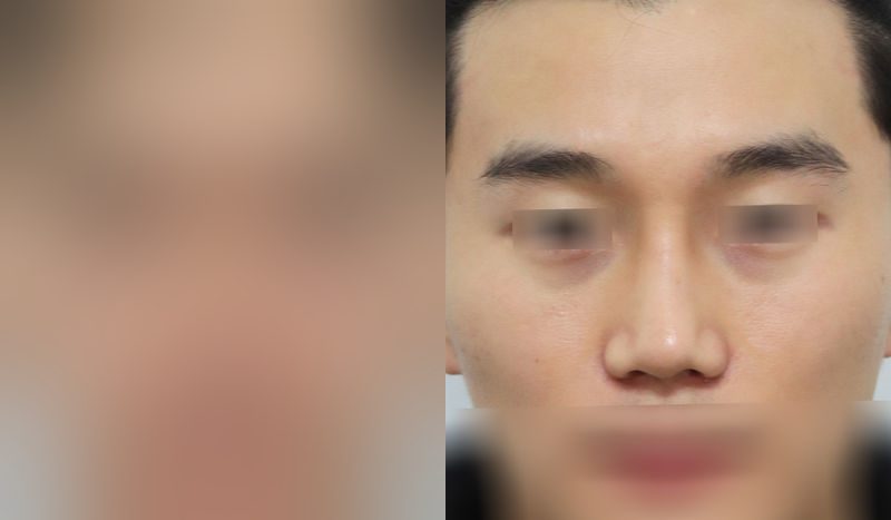Rhinoplasty before-and-after comparison photo — before surgery on the left, after surgery on the right. Nasal bridge + tip correction (septal cartilage) + lateral and medial cartilage + dorsal hump removal + bulbous nose