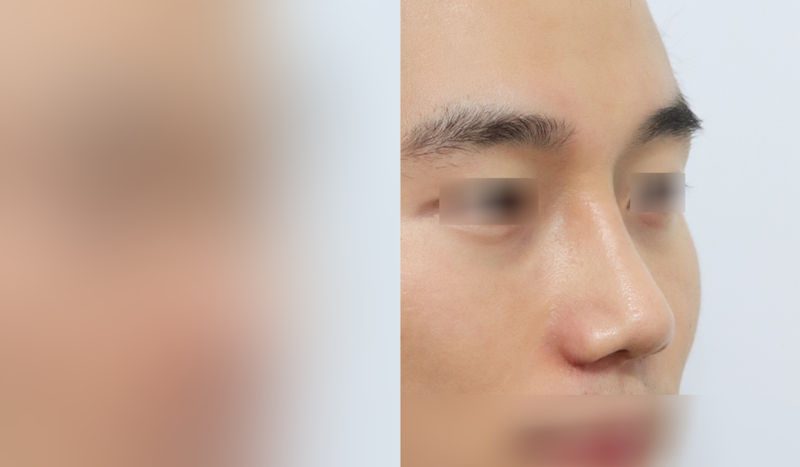 Rhinoplasty before-and-after comparison photo — before surgery on the left, after surgery on the right. Nasal bridge + tip correction (septal cartilage) + lateral and medial cartilage + dorsal hump removal + bulbous nose