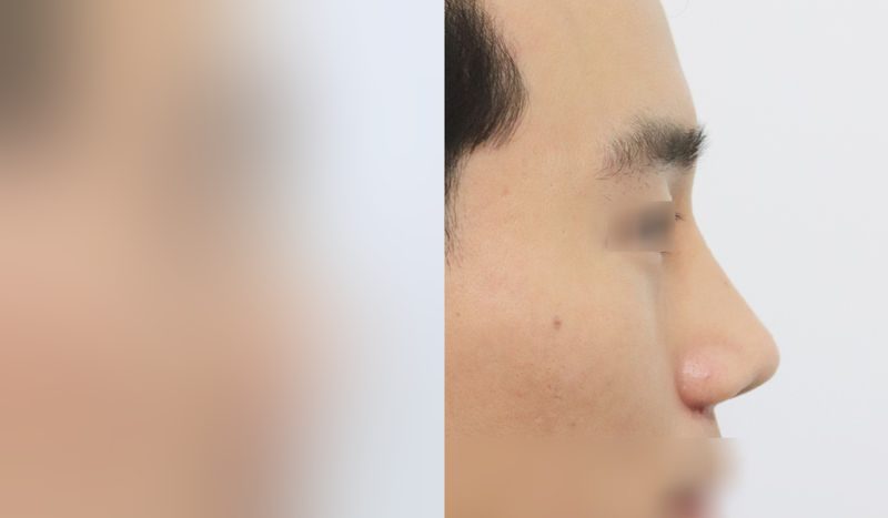 Rhinoplasty before-and-after comparison photo — before surgery on the left, after surgery on the right. Nasal bridge + tip correction (septal cartilage) + lateral and medial cartilage + dorsal hump removal + bulbous nose