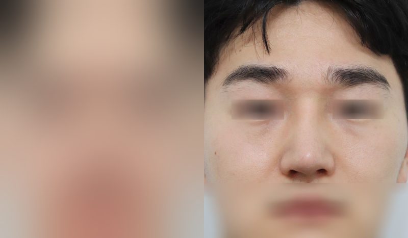 Rhinoplasty before-and-after comparison photo — before surgery on the left, after surgery on the right. Nasal bridge + tip correction (septal cartilage) + lateral and medial cartilage + dorsal hump removal + bulbous nose