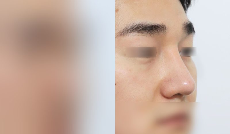 Rhinoplasty before-and-after comparison photo — before surgery on the left, after surgery on the right. Nasal bridge + tip correction (septal cartilage) + lateral and medial cartilage + dorsal hump removal + bulbous nose