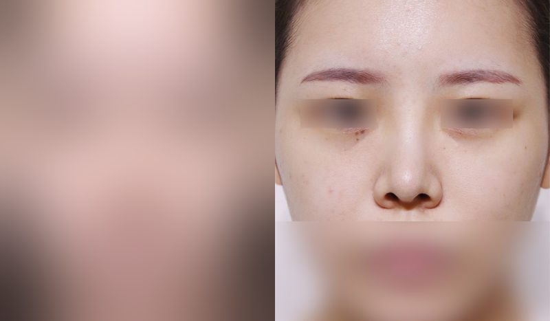 Rhinoplasty before-and-after comparison photo — before surgery on the left, after surgery on the right. Nasal bridge + tip correction (septal cartilage) + lateral and medial cartilage + dorsal hump removal + bulbous nose